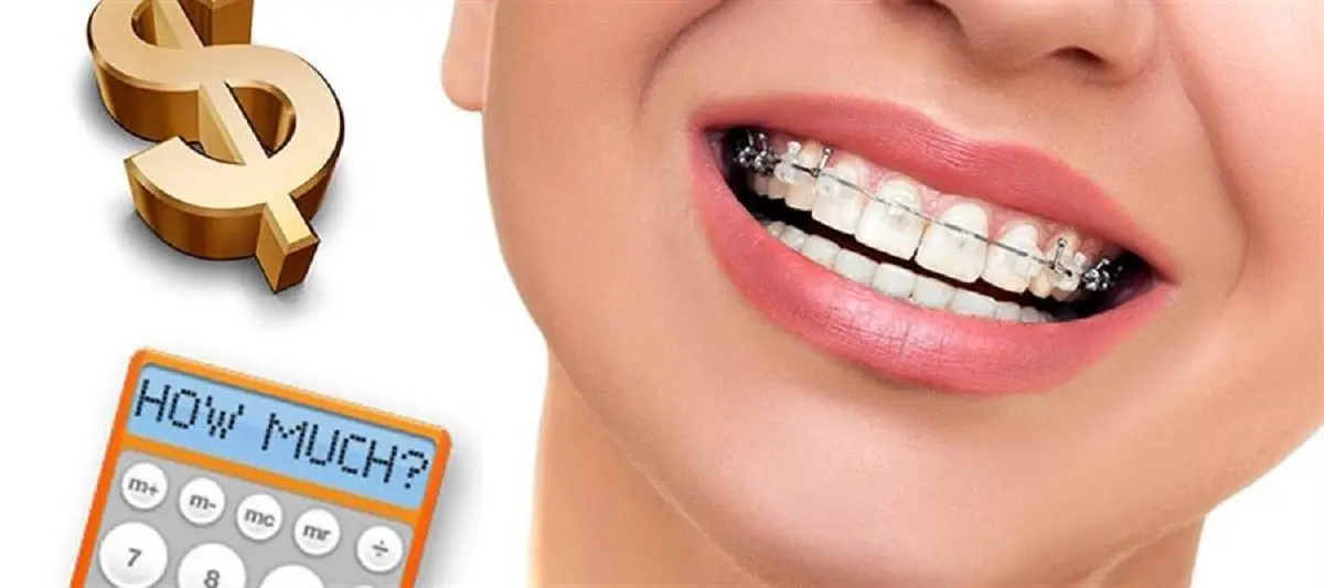 چرا ارتودنسی ثابت کارآمدترین و ارزان‌ترین روش ارتودنسی است؟