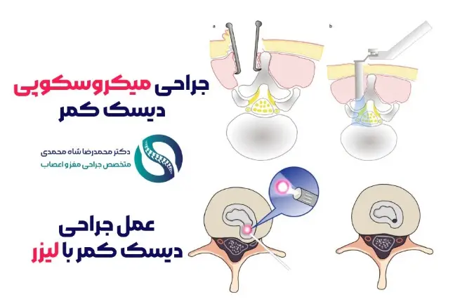 بهترین روش درمان دیسک کمر از نظر متخصص عمل جراحی دیسک کمر در تهران