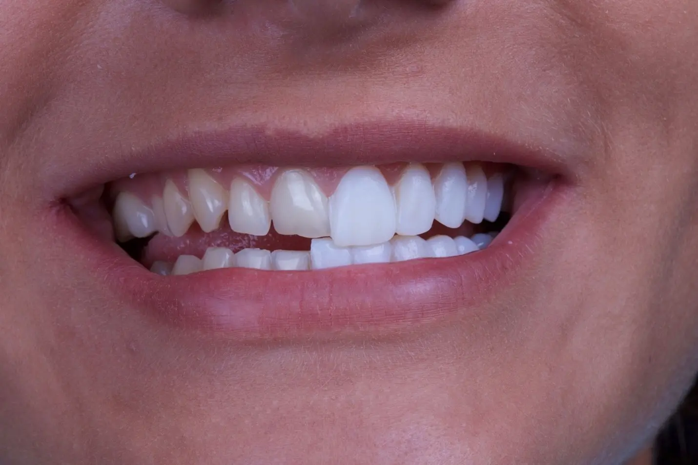 راهنمای جامع هزینه ‌های ترمیم و زیبایی دندان
