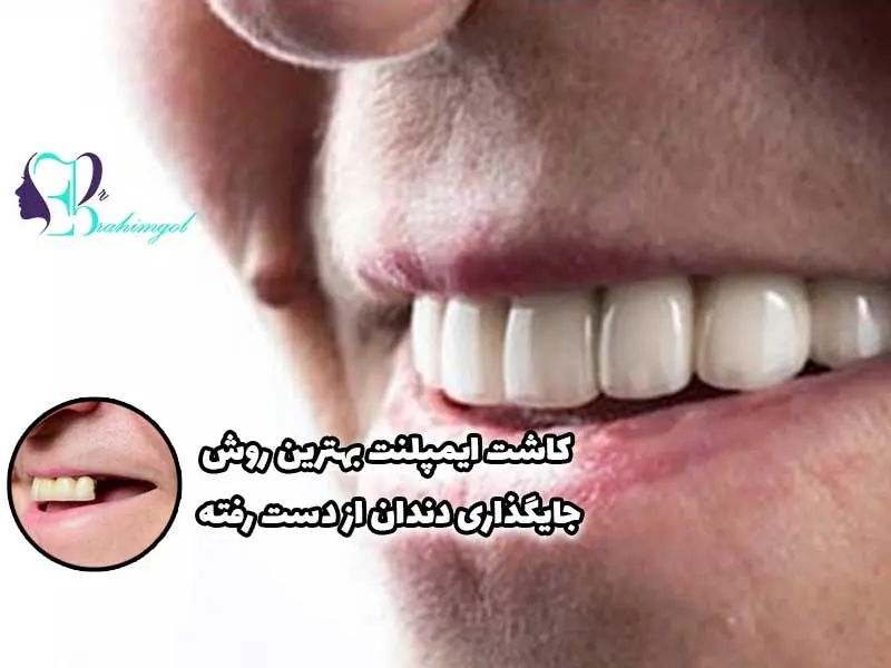 ایمپلنت دندان لیزری با تحویل فوری | هزینه ایمپلنت با لیزر