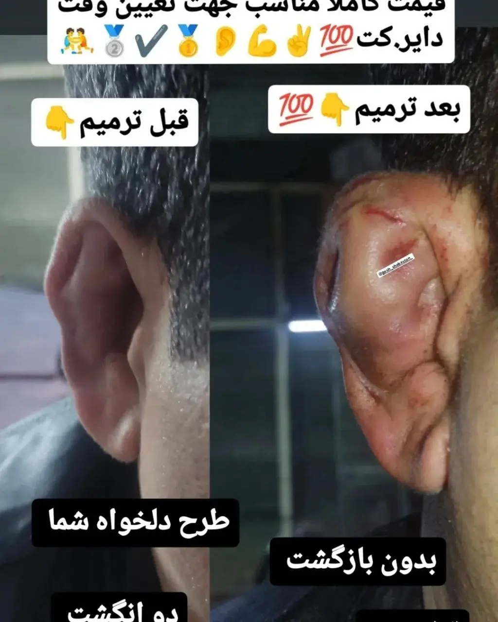 چند می‌گیری گوش بشکنی؟ | درباره پدیده عجیب شکستن عمدی گوش بین جوانان 