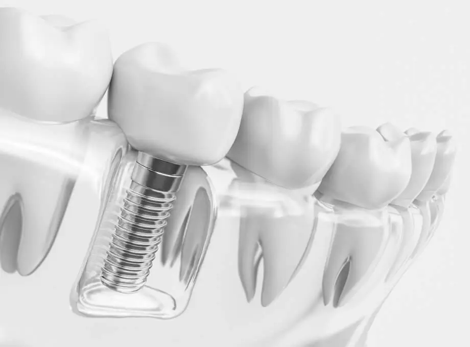 ایمپلنت آلمانی یا سوئیسی ؟ کدام بهتر است؟
