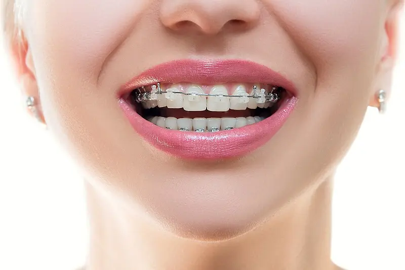 با ارتودنسی زیباتر لبخند بزنید + معرفی متخصص ارتودنسی