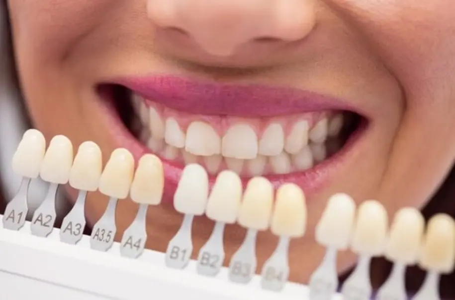 لمینت دندان بهتر است یا کامپوزیت؟