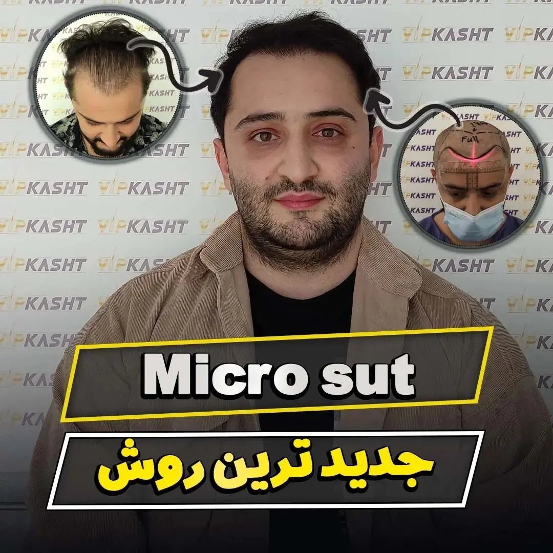 کاشت مو در تهران با خط رویش طبیعی و پرتراکم