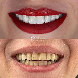 روش های تضمینی رسیدن به طرح لبخند جذاب