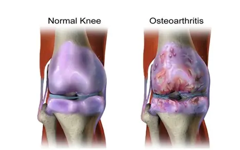 علائم و راه های درمان آرتروز زانو 