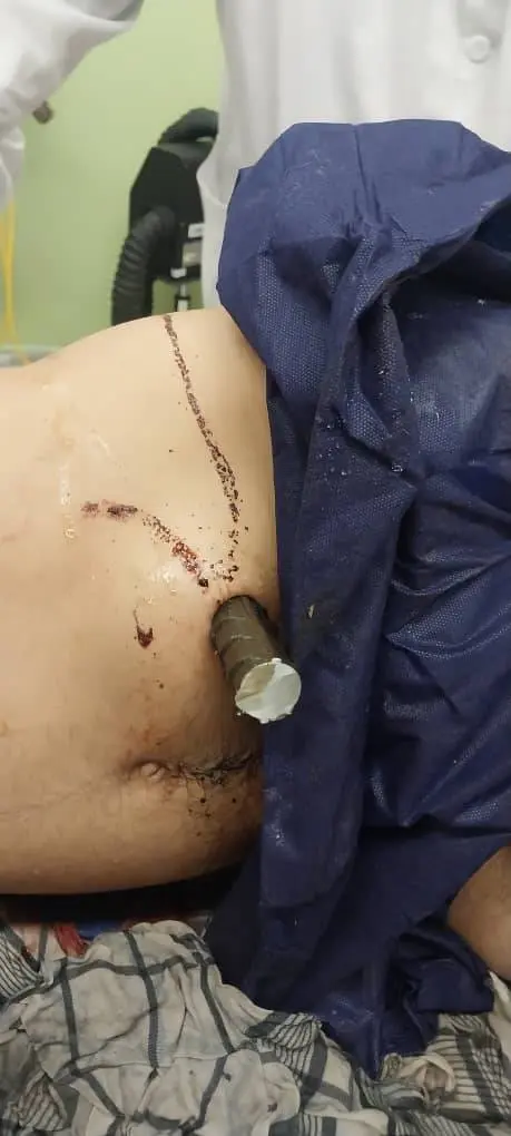 فرو رفتن میلگرد به کمر کارگر ۲۵ ساله + عکس و فیلم