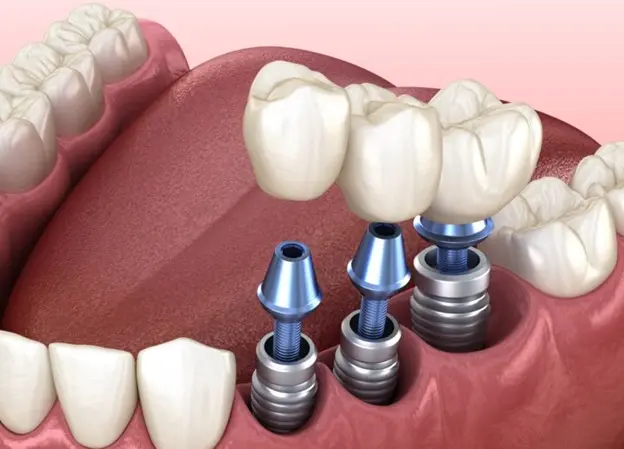 بازسازی لبخند با ایمپلنت دندان در کلینیک دندانپزشکی