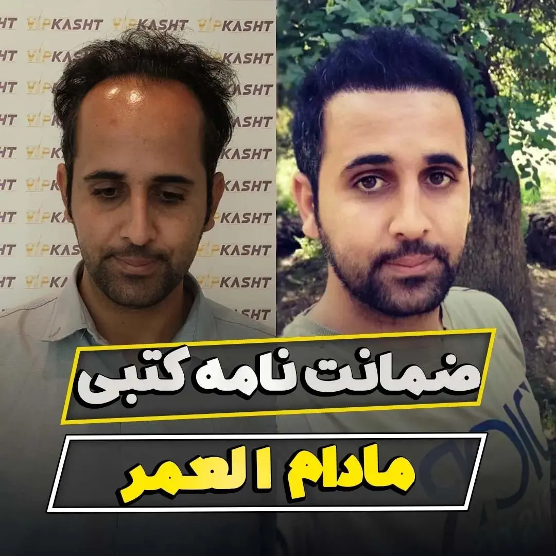 کاشت مو در تهران با خط رویش طبیعی و پرتراکم