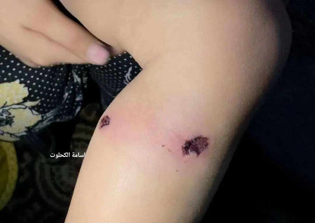 اسرائیلی ها پای کودک را سوزانده و میخ در پایش فرو کردند