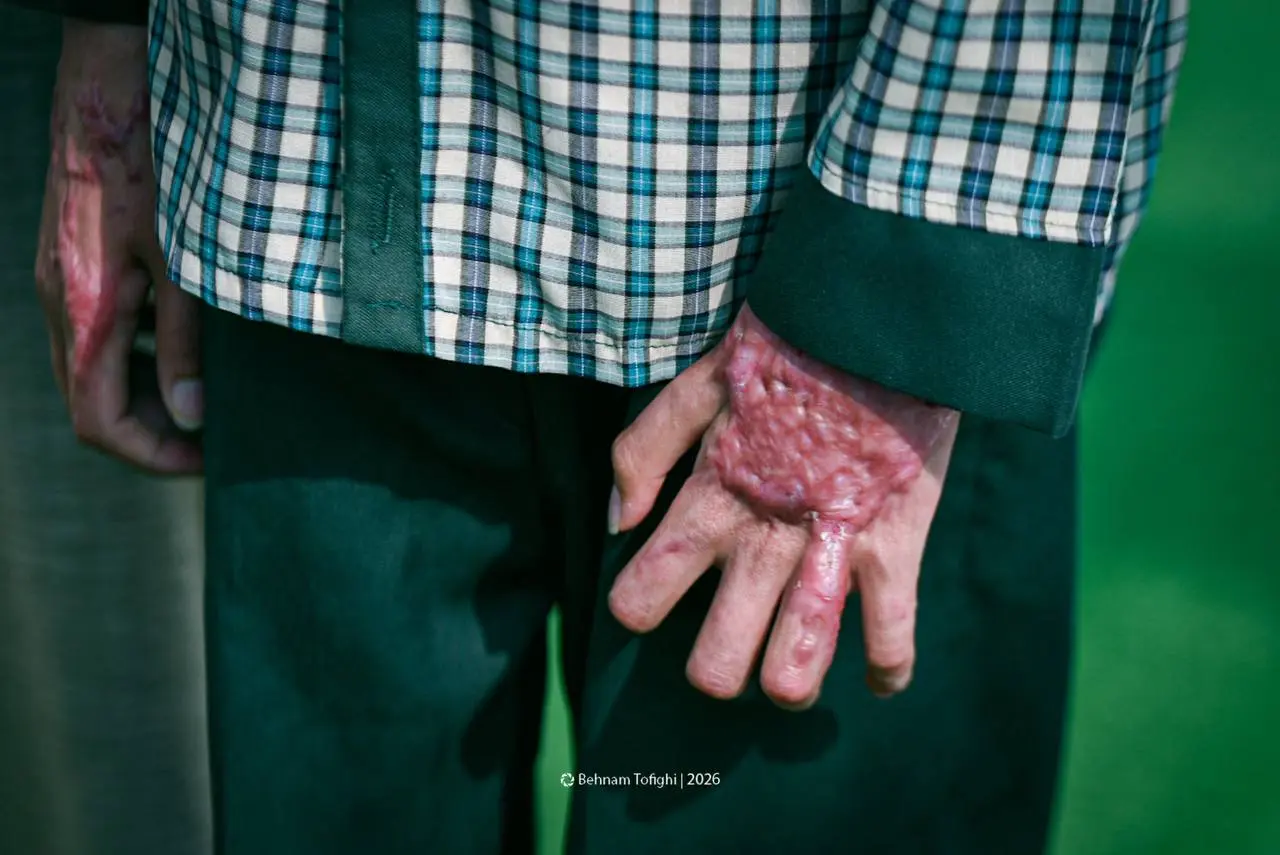 تصویری تلخ از آثار بمباران روی صورت دانشآموز مینابی + عکس