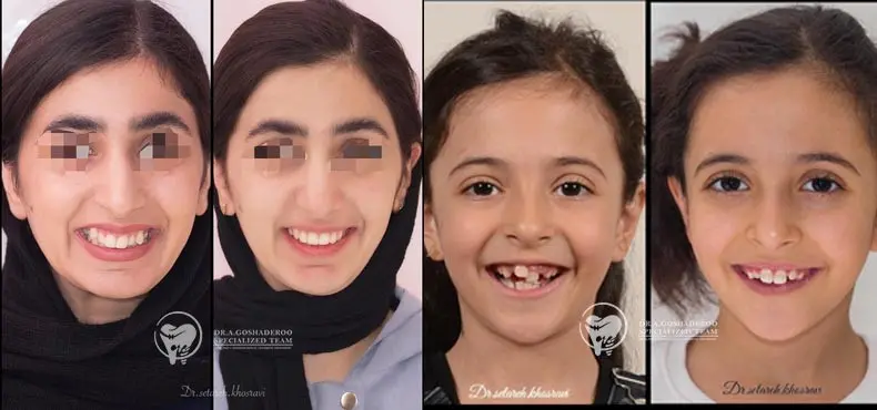 سن مناسب ارتودنسی دندان