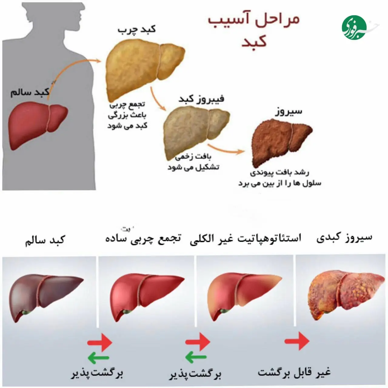 کبد چرب؛ بیماری خاموشی که علامتی ندارد اما خطرناک است + اینفوگرافیک