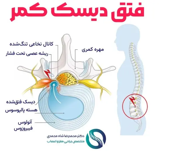 بهترین روش درمان دیسک کمر از نظر متخصص عمل جراحی دیسک کمر در تهران
