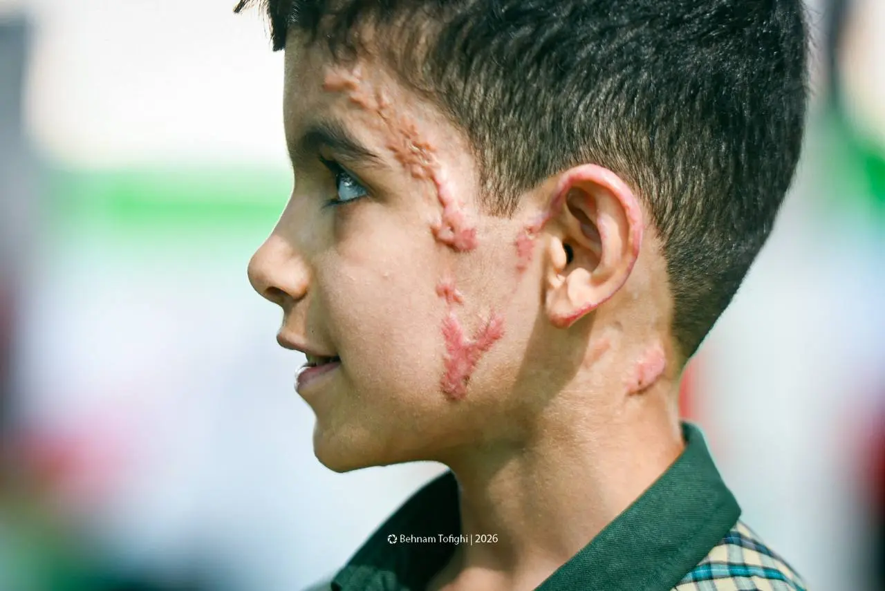 تصویری تلخ از آثار بمباران روی صورت دانشآموز مینابی + عکس