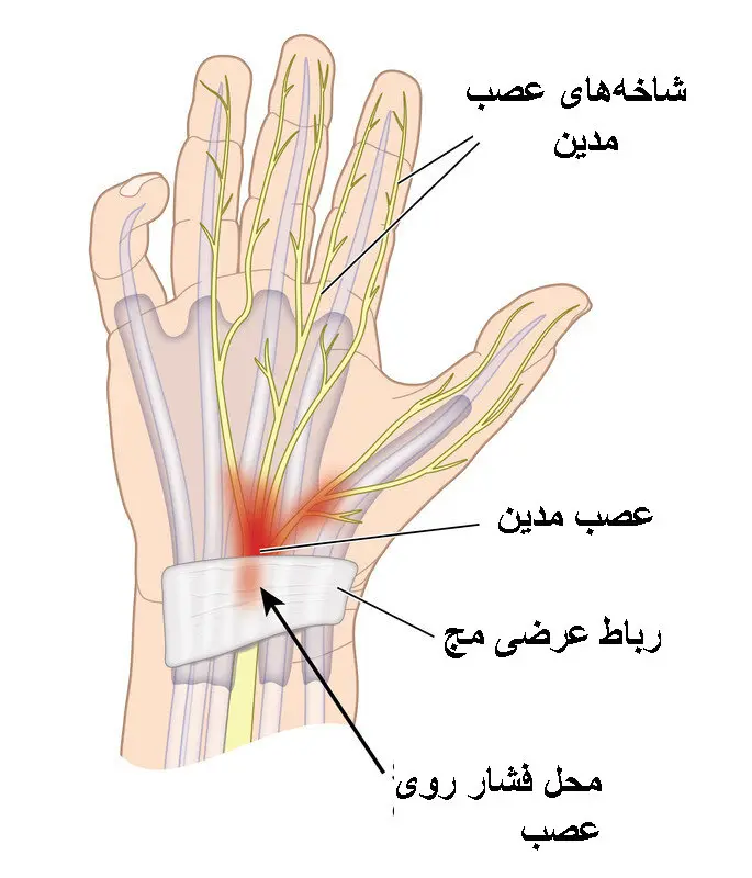 چطور درد مچ در سندرم تونل کارپال را تسکین دهیم؟