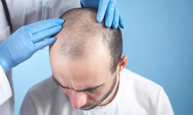 عوارض حاصل از کاشت مو چیست؟