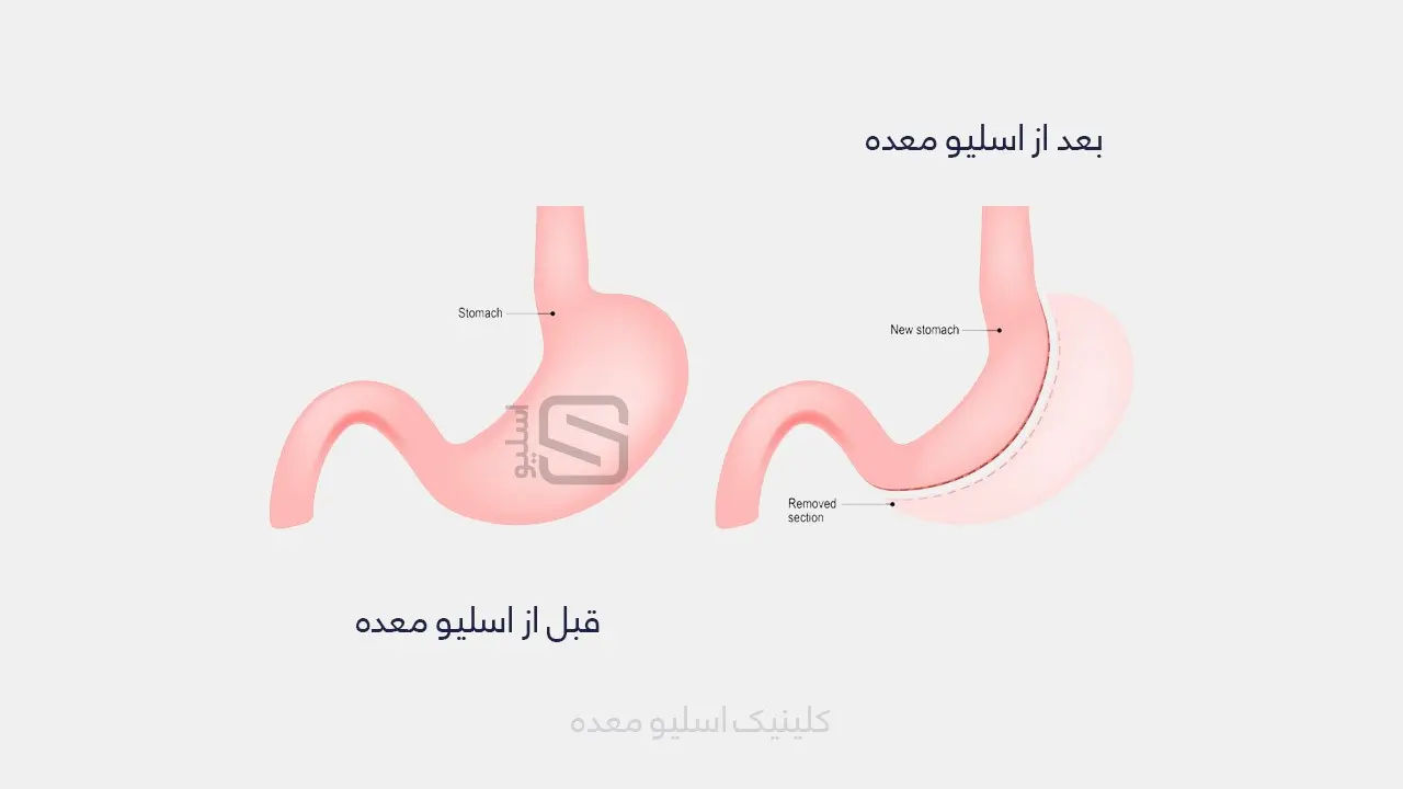 آشنایی با 2 روش لاغری مدرن + 2 روش منسوخ شده