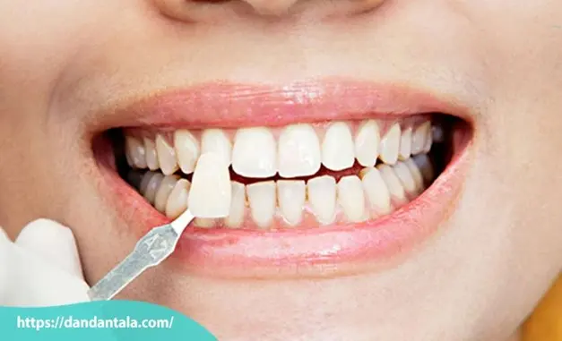 اصلاح طرح لبخند با لمینت یا کامپوزیت کدام یک بهتر است؟