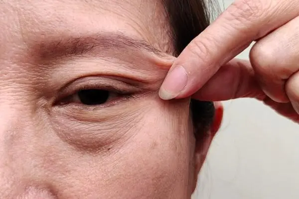 افتادگی پوست صورت، راه‌های درمان شل شدن پوست صورت