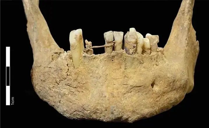دندانهایی با سیمکشی طلایی در گورستان ۵۰۰ ساله