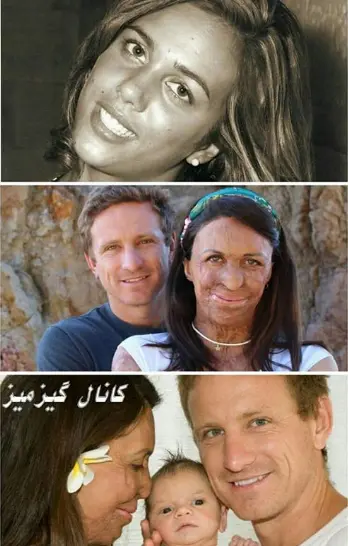 زندگی با زن ورزشکار و مدل پس از سوختگی صورت و بدن +عکس