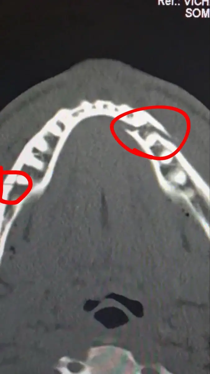 انتقال بوکسور آمریکایی به بیمارستان با شکستگی فک (عکس)