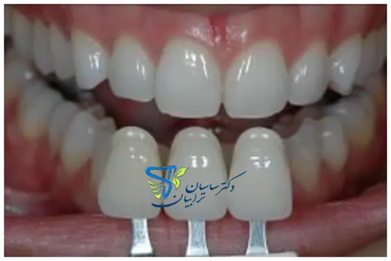 آشنایی با شاخص‌های بهترین دندانپزشک زیبایی