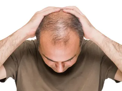درمان قطعی طاسی و ریزش مو
