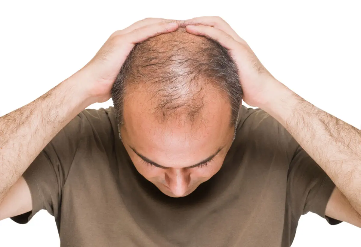 درمان قطعی طاسی و ریزش مو