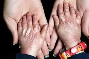 نگرانی از تامین پایدار پانسمان‌های خاص بیماران پروانه‌ای؛ قول مساعد مسئولان برای تامین بدون مشکل این نیاز