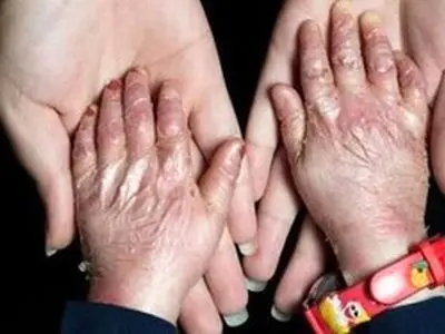 نگرانی از تامین پایدار پانسمان‌های خاص بیماران پروانه‌ای؛ قول مساعد مسئولان برای تامین بدون مشکل این نیاز

