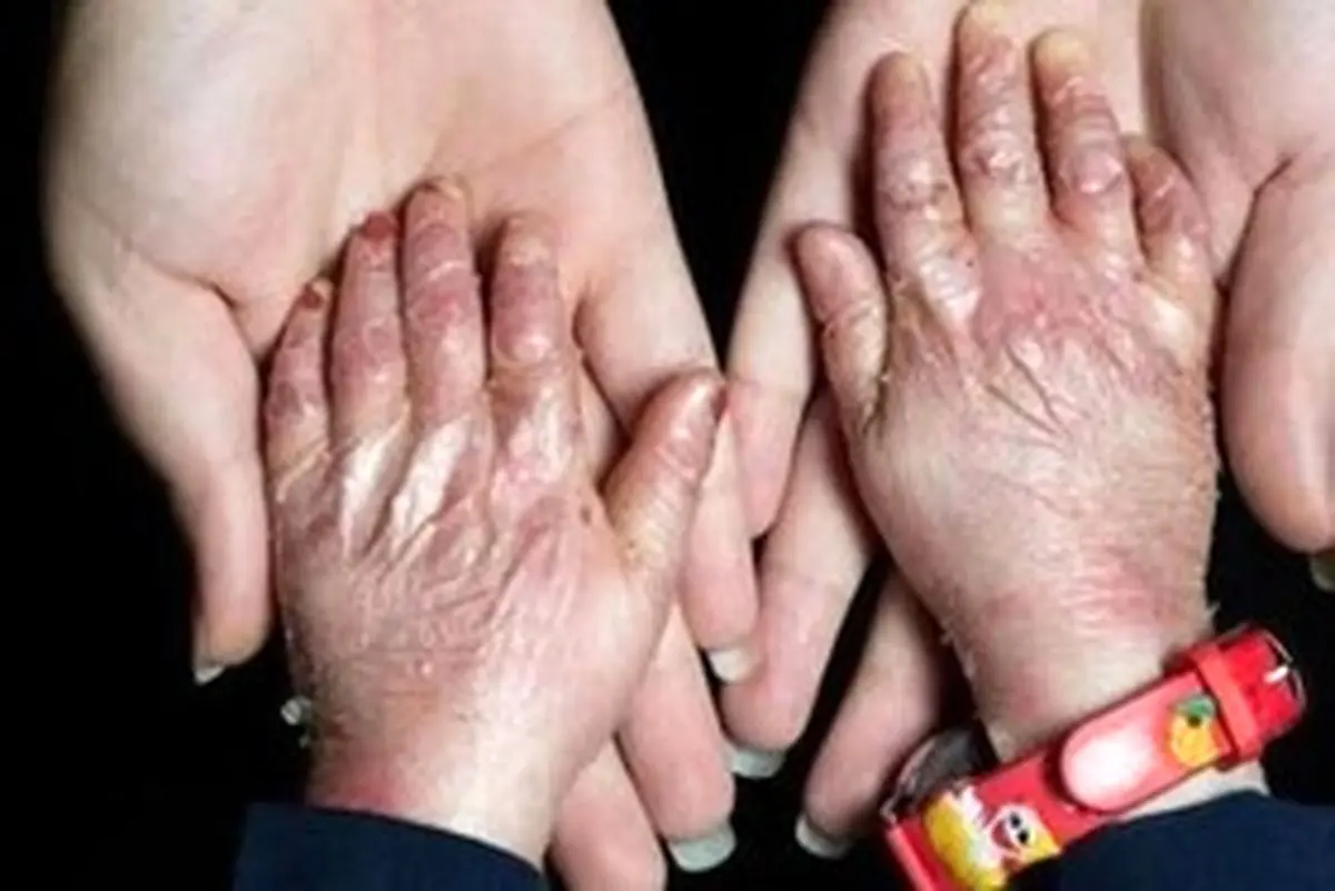 نگرانی از تامین پایدار پانسمان‌های خاص بیماران پروانه‌ای؛ قول مساعد مسئولان برای تامین بدون مشکل این نیاز

