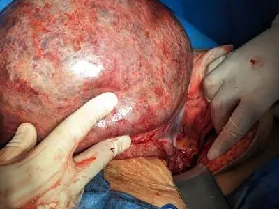 خروج توده‌ی ۴ کیلویی از شکم بیمار شوشی