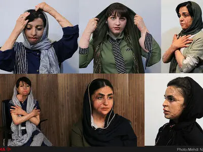 بودجه درمان دانش‌آموزان شین‌آبادی را ندادند/پول برای تامین پروتز نداشتیم