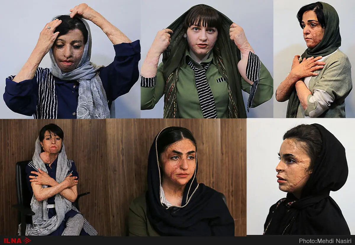 بودجه درمان دانش‌آموزان شین‌آبادی را ندادند/پول برای تامین پروتز نداشتیم
