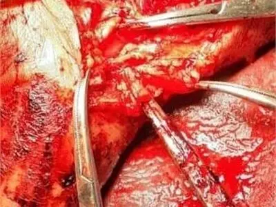تیم جراحی بیمارستان صحنه مانع از قطع دست جوان ۲۲ ساله شد