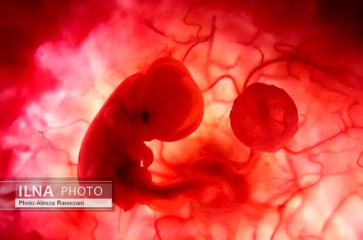 افزایش 35 درصدی سقط جنین در گیلان