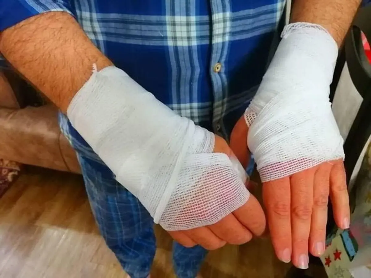 مرگ سالانه ۳ هزار ایرانی در اثر سوختگی 