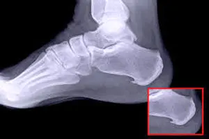 خار پاشنه چطور ایجاد می‌شود؟