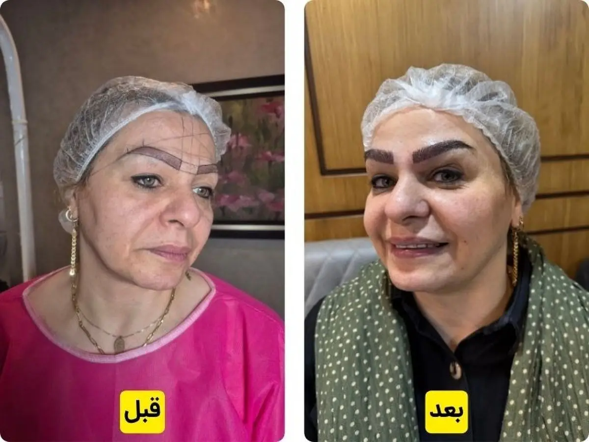 کاشت ابرو بدون جراحی به روش سلبریتی متد