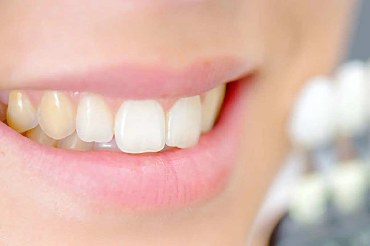 علت زرد شدن دندان‌ها چیست؟ 