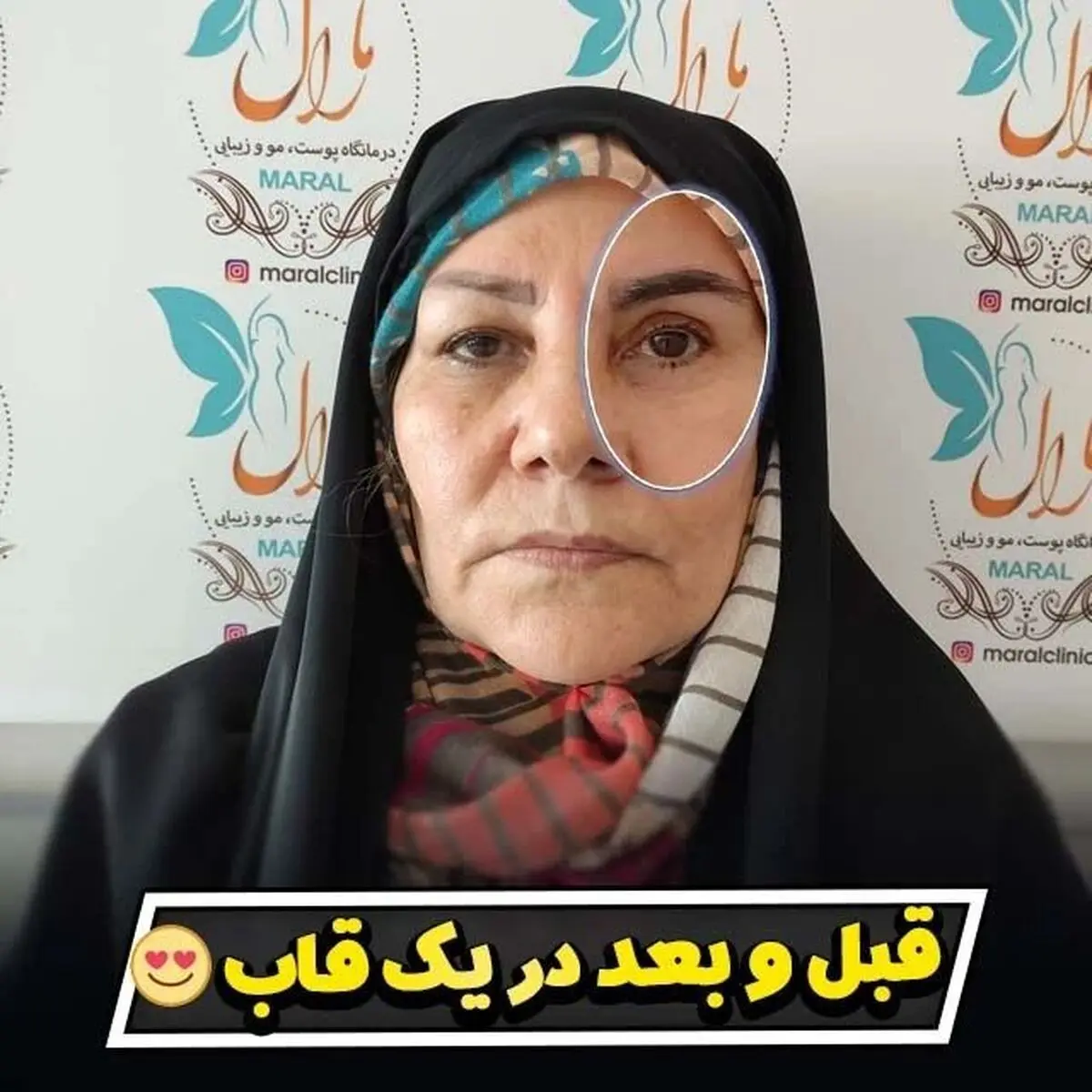 بهترین کلینیک درمان افتادگی پلک در تهران