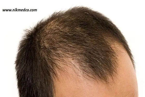 راهکارهای جلوگیری از ریزش مو و حفظ زیبایی موها