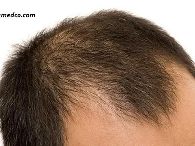راهکارهای جلوگیری از ریزش مو و حفظ زیبایی موها