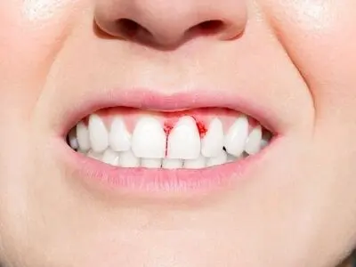 بیماری هشداردهنده لثه کدام است؟