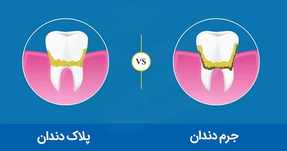 روش‌های سنتی جِرم‌گیریِ دندان در خانه