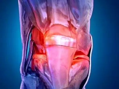 آرتروز دیگر بیماریِ سنین بالا نیست