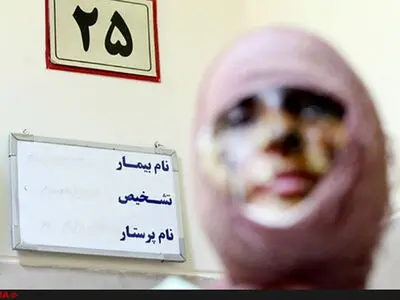 سوختگی 14 درصدی دختر 25 ساله بر اثر اسیدپاشی/ چشم‌هایش آسیب جدی ندیده‌اند